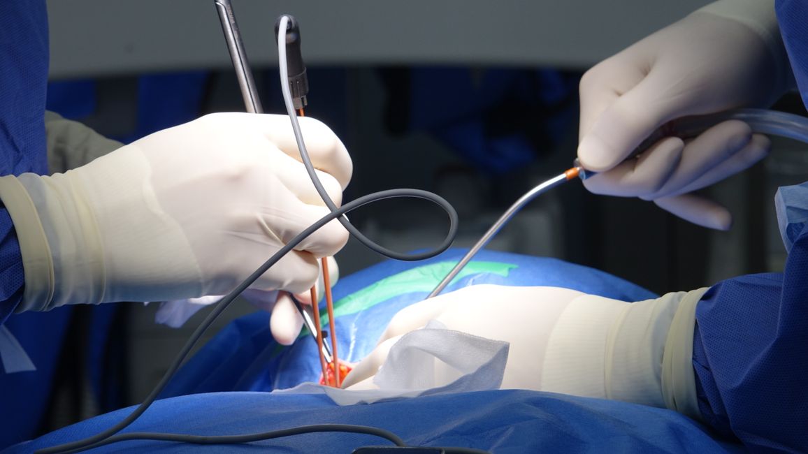 Picture for A spark of hope: nerve implant offers relief for long-term depression