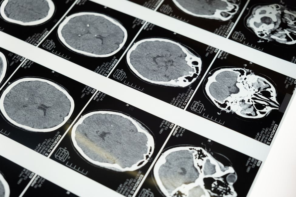 Picture for Brain scans reveal nutrient gap that may be connected to anxiety